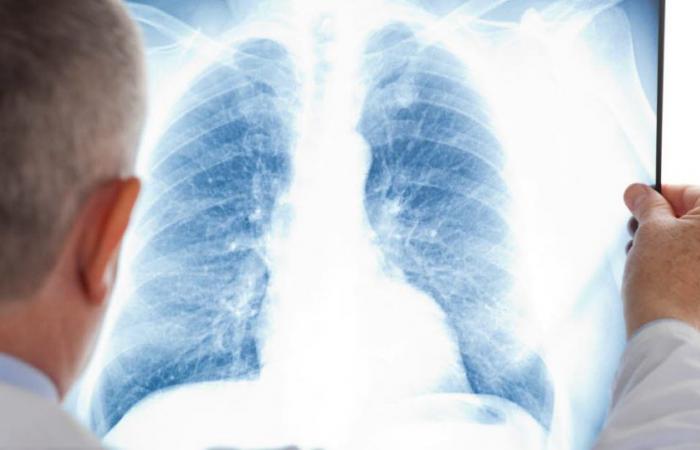 Warum sind sie auch von Lungenkrebs betroffen?