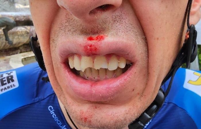 Tour de France 2024: „Drei abgebrochene Zähne!“ Das große Missgeschick eines Läufers kurz vor dem Start des Grande Boucle