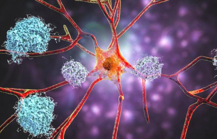 Alzheimer: Grünes Licht von der Europäischen Arzneimittel-Agentur für die erste Behandlung, die die Krankheit verlangsamt: „ein ermutigendes Signal“