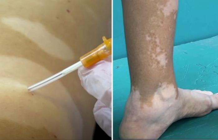 Gesundheit: Ein in Reunion getestetes Mittel gegen Vitiligo