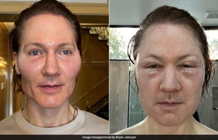 Das Gesicht des Tech-Millionärs Bryan Johnson „explodiert“, nachdem ein Anti-Aging-Experiment schief gelaufen ist