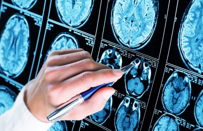 HIRNTRAUMA und ALZHEIMER: Was ist der Zusammenhang?