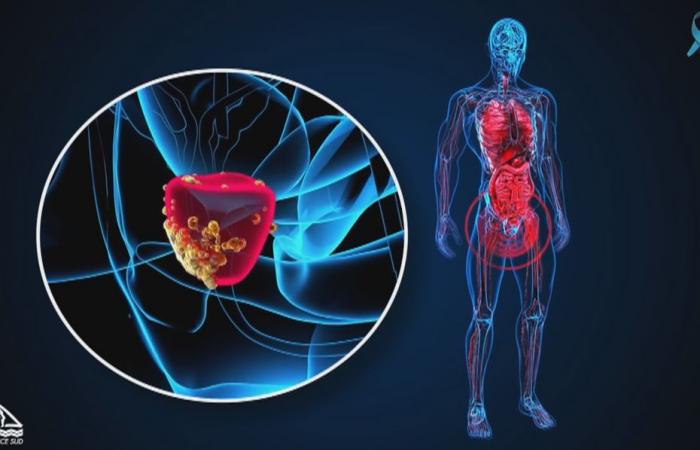 Sechs Dinge, die Sie über Prostatakrebs in Neukaledonien wissen sollten