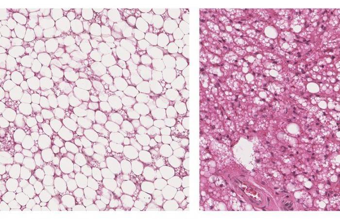 Braunes Fett: Warum ist dieses wenig bekannte Fettgewebe so nützlich für Ihre Gesundheit? Eine Studie aus Toulouse eröffnet neue Perspektiven