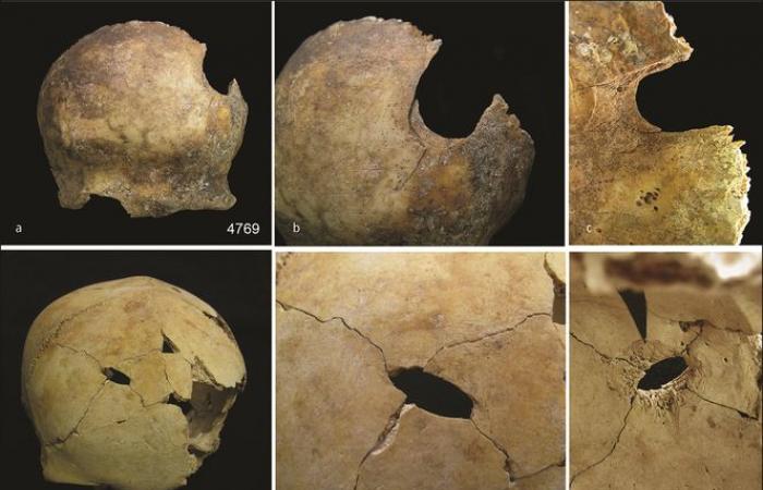 Vor 4.000 Jahren soll in England eine Episode von Massenkannibalismus stattgefunden haben