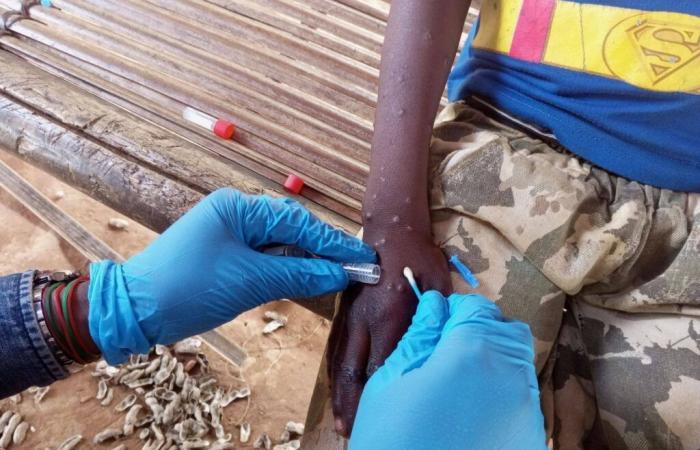 WHO besorgt über Mpox-Situation in Afrika | APAnews