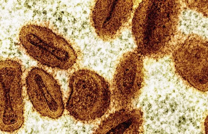 Erster Fall von Mpox im Kosovo bei einem Reisenden aus Westafrika