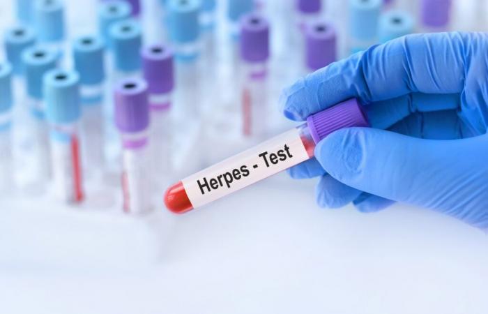 HERPESVIRUS: Auslöser für Alzheimer?