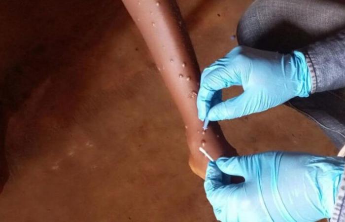 Mpox: Ein erster Fall im Zusammenhang mit der in Frankreich identifizierten neuen Variante