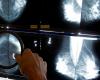 Die Canadian Cancer Society fordert ein Brustkrebs-Screening ab dem 40. Lebensjahr