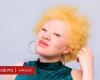 Albinismus: Mythen über die Krankheit führten dazu, dass Männer mich misshandelten