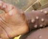 MPOX trifft Kinder in Burundi hart